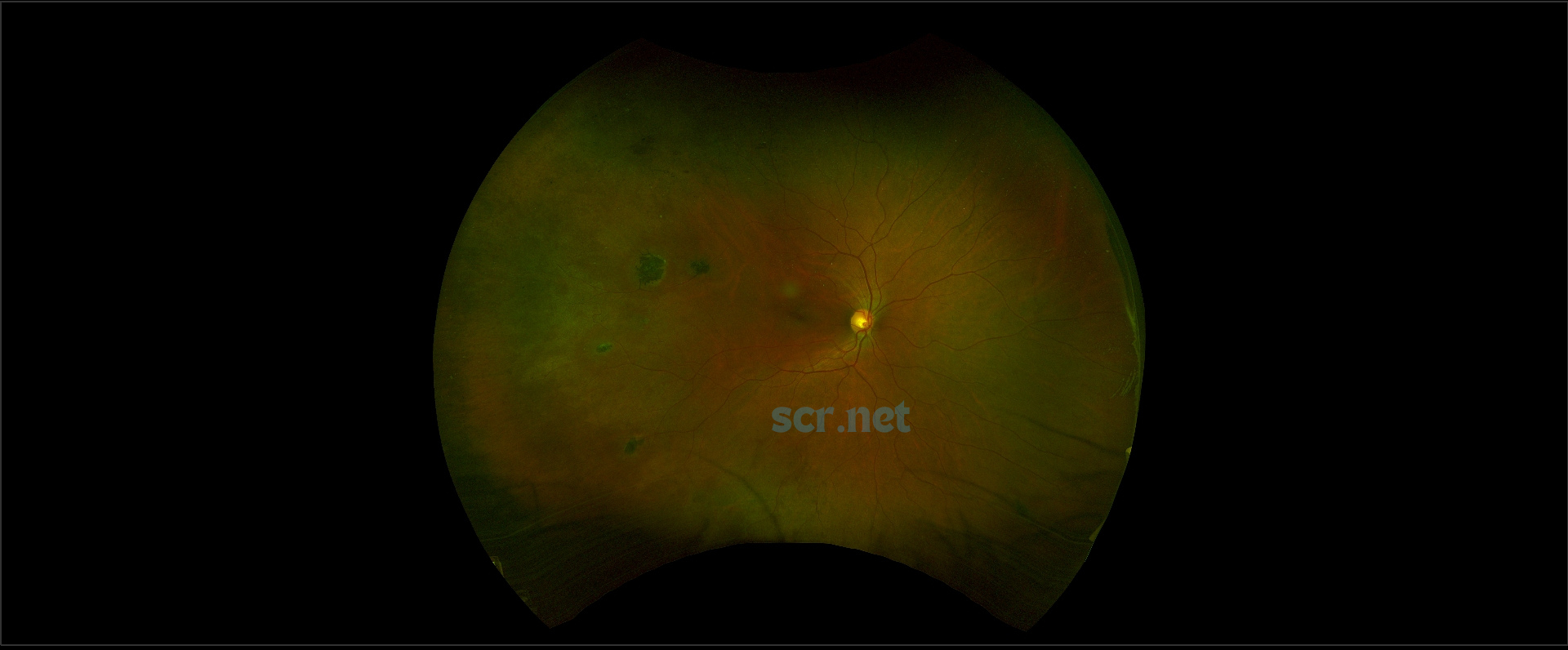 widefield fundus photograph of the retina of a patient living with sickle cell retinopathy