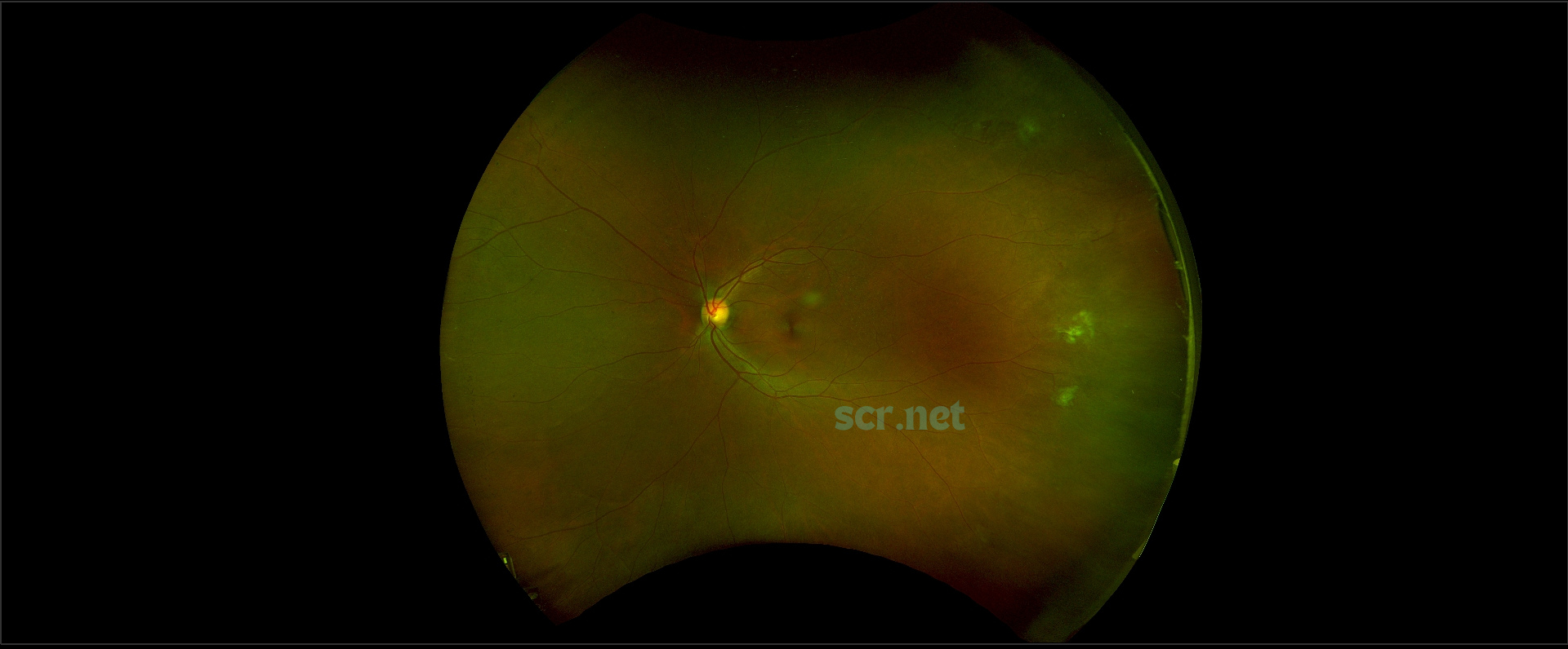 widefield fundus photograph of the retina of a patient living with sickle cell retinopathy