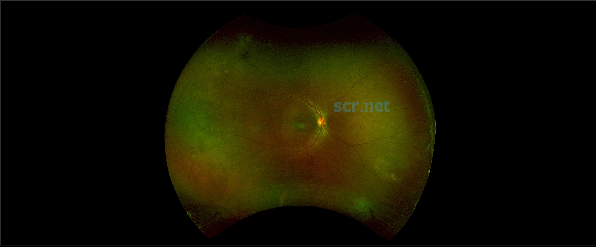 widefield fundus photograph of the retina of a patient living with sickle cell retinopathy